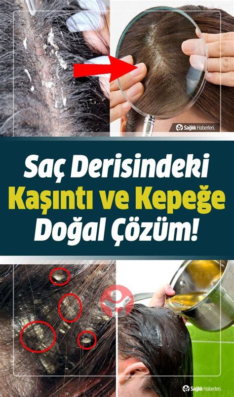 Saç Derisinde Kaşıntıyı Gideren Bitkisel Maskeler